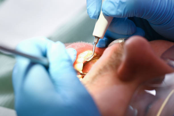 Best Emergency Treatment for Toothache in Herriman, UT